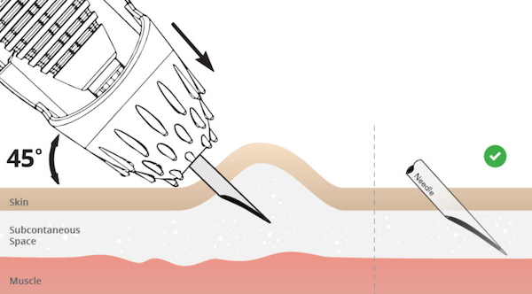 Correct vaccination technique. The vaccination gun and needle need to be at 45O angle and not go into the muscle. Source: Zoetis