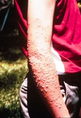 Blisters on young mans arm.
